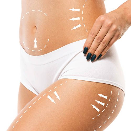 Cellulite removal plan. The black markings on young woman body preparing for plastic surgery. Concept of body correction, beauty, surgery procedure, liposuction. Fit female body. Copyspace.